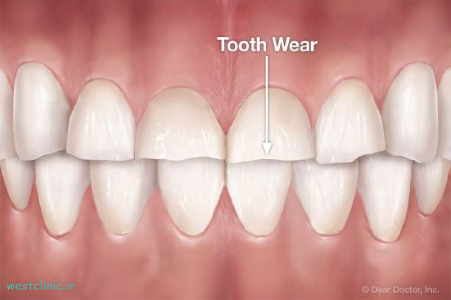 جلوگیری از سایش دندان