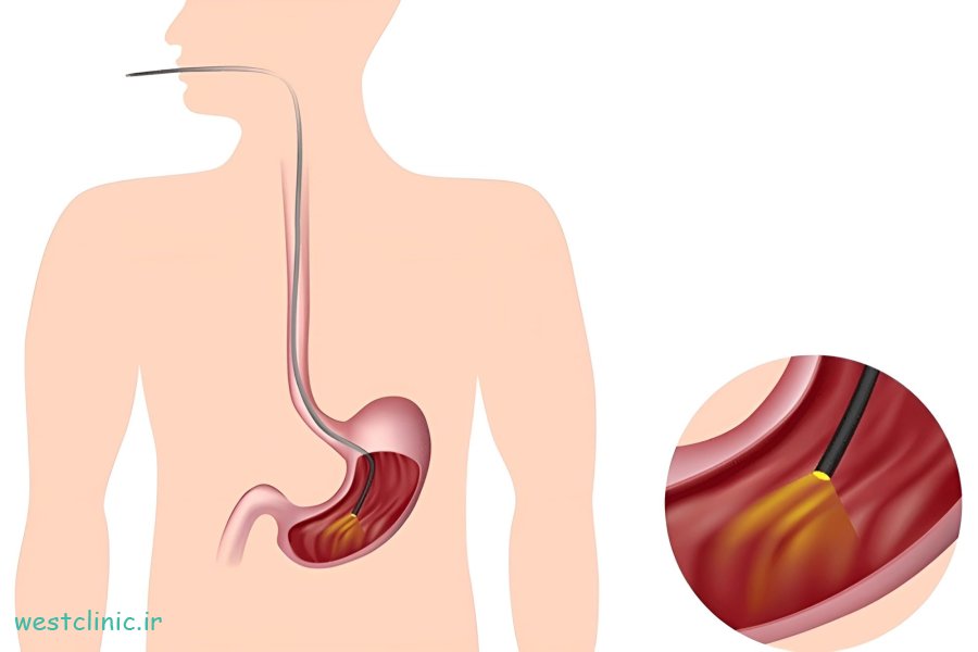 آندوسکوپی گوارشی