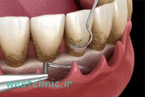 جرم‌گیری دندان؛ آیا باعث آسیب به مینای دندان می‌شود؟