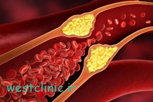 تنگی عروق کرونر دلایل و علائم و روش‌ های تشخیص پیشرفته