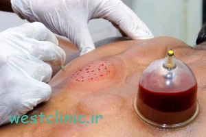 آیا حجامت پایه علمی دارد؟
