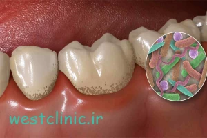 عفونت دندان؛ چه علائمی دارد و چرا نباید پشت گوش انداخته شود؟