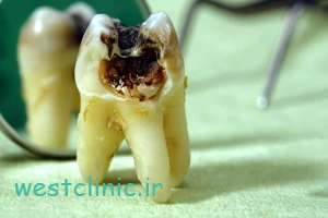پوسیدگی دندان؛ چگونه آن را زود تشخیص دهیم و به موقع درمان کنیم؟