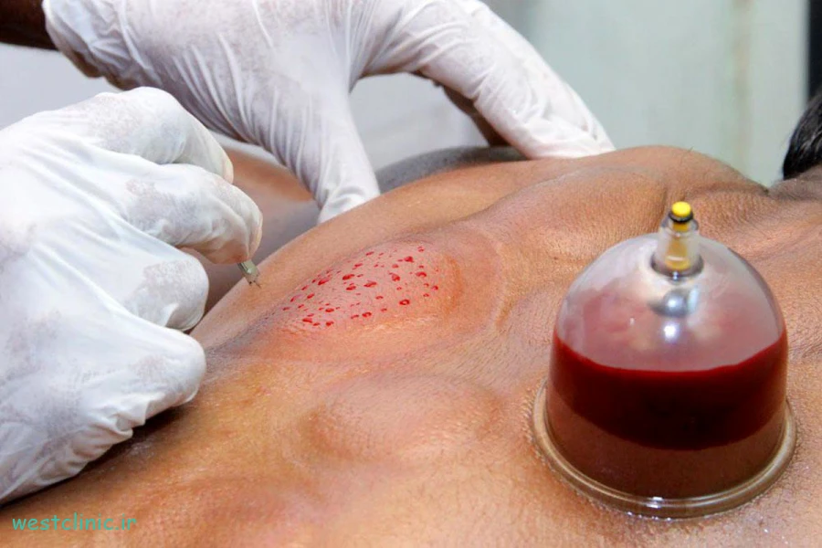 آیا حجامت پایه علمی دارد؟
