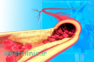 تنگی عروق کرونر چیست و چگونه زمینه را برای ابتلا به نارسایی قلبی فراهم می‌کند؟