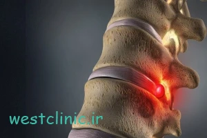 تفاوت دیسک کمر و آرتروز در چیست؟