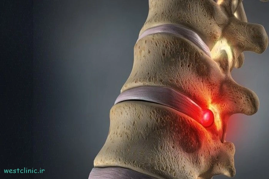 تفاوت دیسک کمر و آرتروز در چیست؟