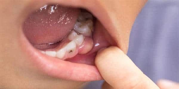 عفونت دندان؛ چه علائمی دارد و چرا نباید پشت گوش انداخته شود؟ 2