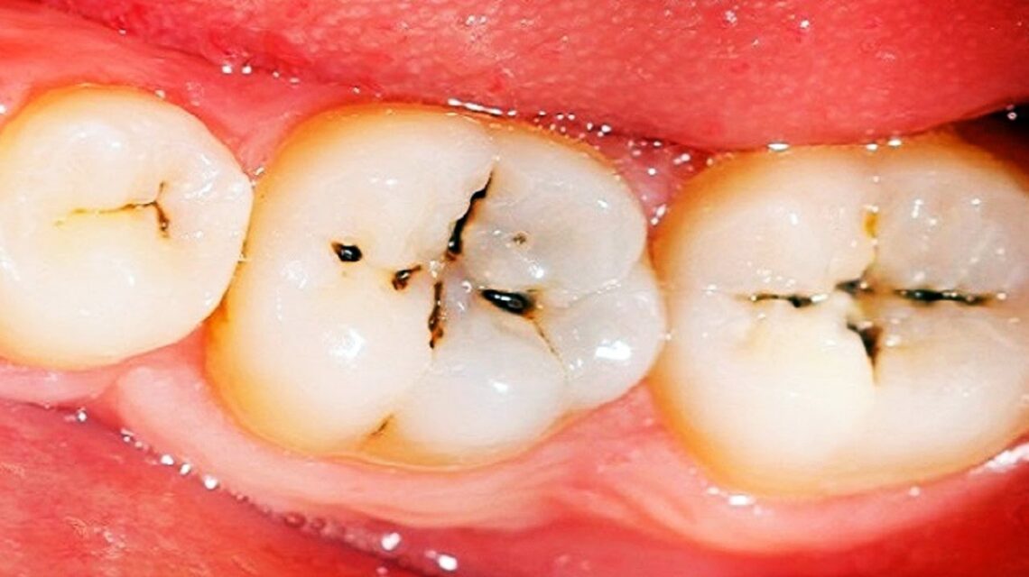 چگونه پوسیدگی دندان را زود تشخیص دهیم و به موقع درمان کنیم؟