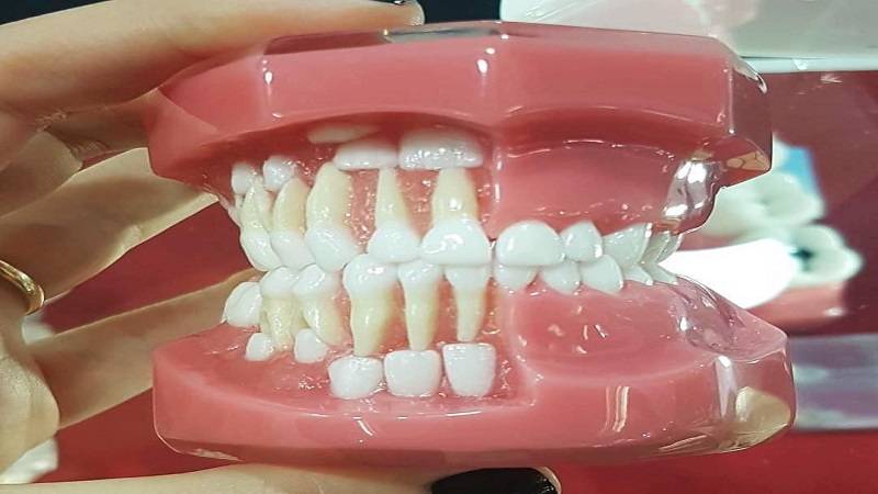دندان شیری؛ چه زمانی مداخله لازم است؟