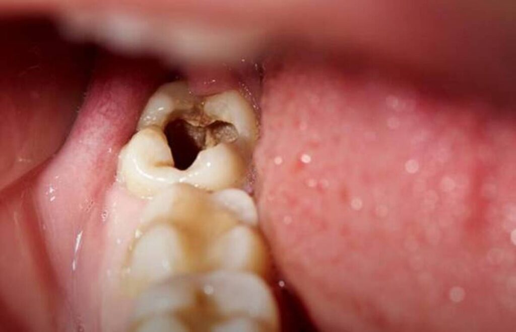 پوسیدگی دندان؛ چگونه آن را زود تشخیص دهیم و به موقع درمان کنیم؟